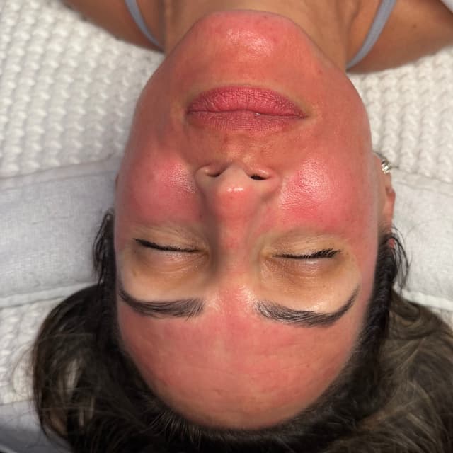Microneedling package of 3 at One Skin by Mabel in Palmetto Bay, FL